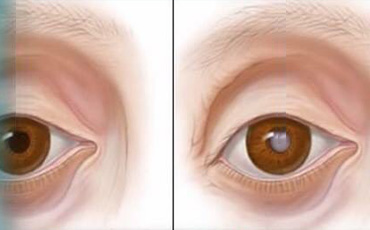 ต้อกระจก Cataract