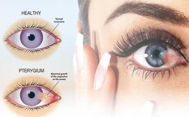 ต้อเนื้อ Pterygium