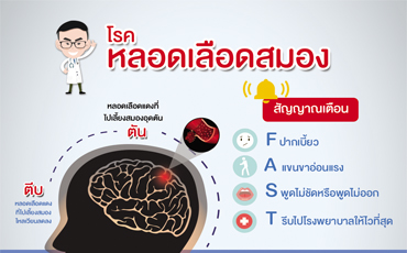 โรคหลอดเลือดสมอง