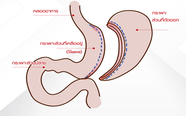 ผ่าตัดกระเพาะลดน้ำหนัก