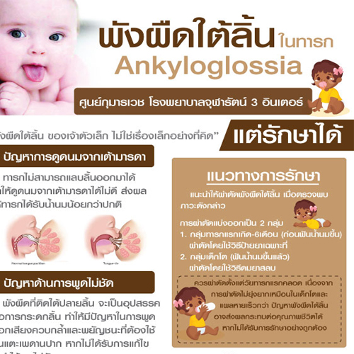 พังผืดใต้ลิ้น ทำให้ลูกดูดนมใม่ได้ พูดไม่ชัด ตัดหรือไม่ตัดดี ?