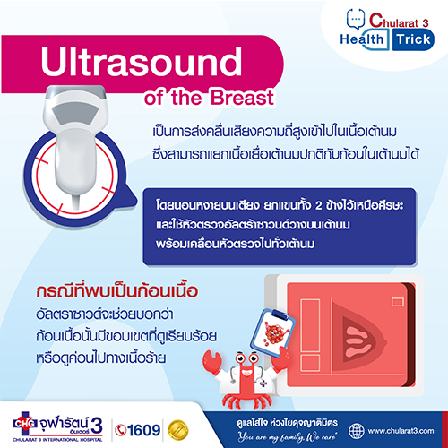 การตรวจอัลตร้าซาวนด์เต้านม (Ultrasound of the Breast)