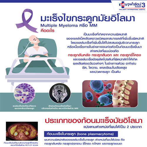 มะเร็งไขกระดูกมัยอิโลมา (Multiple myeloma) คืออะไร