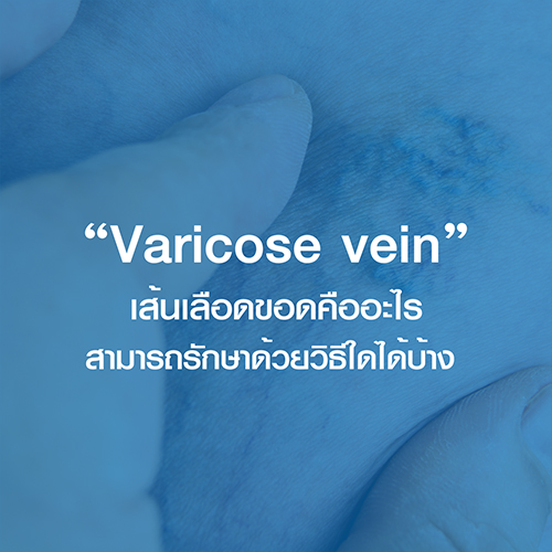 เส้นเลือดขอดคืออะไรและสามารถรักษาด้วยวิธีใดได้บ้าง (Varicose vein)