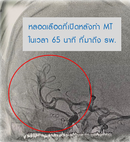 ศูนย์โรคหลอดเลือดสมองและระบบประสาท